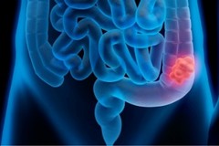 Tumore del Colon retto: un enzima "l’osservato speciale"