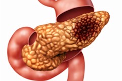Cancro del pancreas: cosa aspettarsi dalle terapie avanzate?