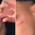 Sfida "Cicatrice francese " su TikTok, allarme nelle scuole