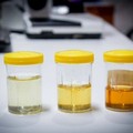 Il colore dell'urina può rivelare molto sulla tua salute