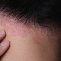 Psoriasi e protezione della pelle: se ne parla in un incontro dello SPI Giovinazzo