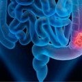 Tumore del Colon retto: un enzima "l’osservato speciale "