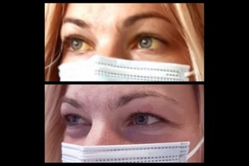 La sindrome da bilirubina pronta per essere curata