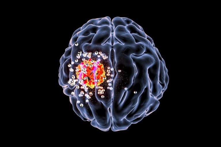 Il glioblastoma