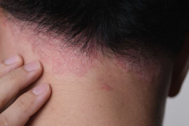 Psoriasi