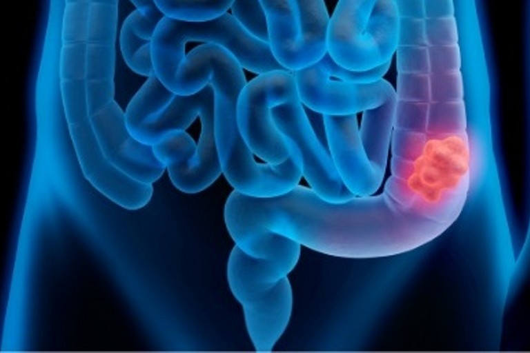 Tumore del Colon