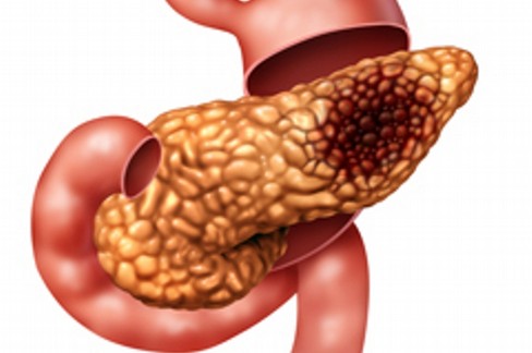 Cancro del pancreas